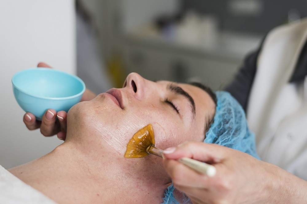 Chemical peeling for acne and pigmentation