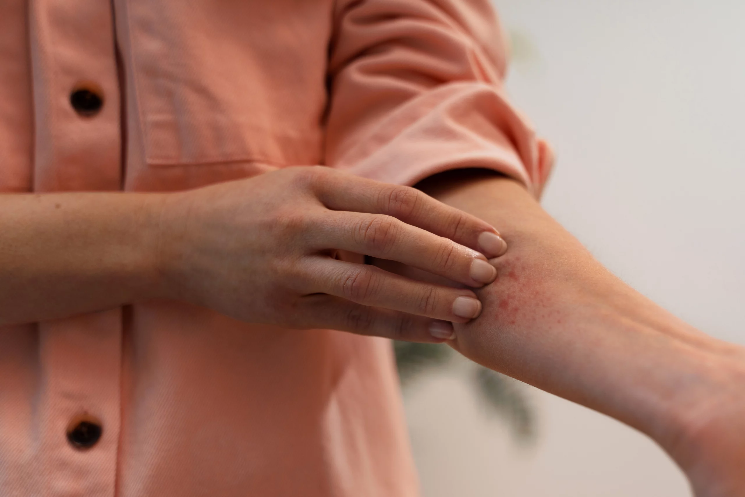 Skin allergies and eczema