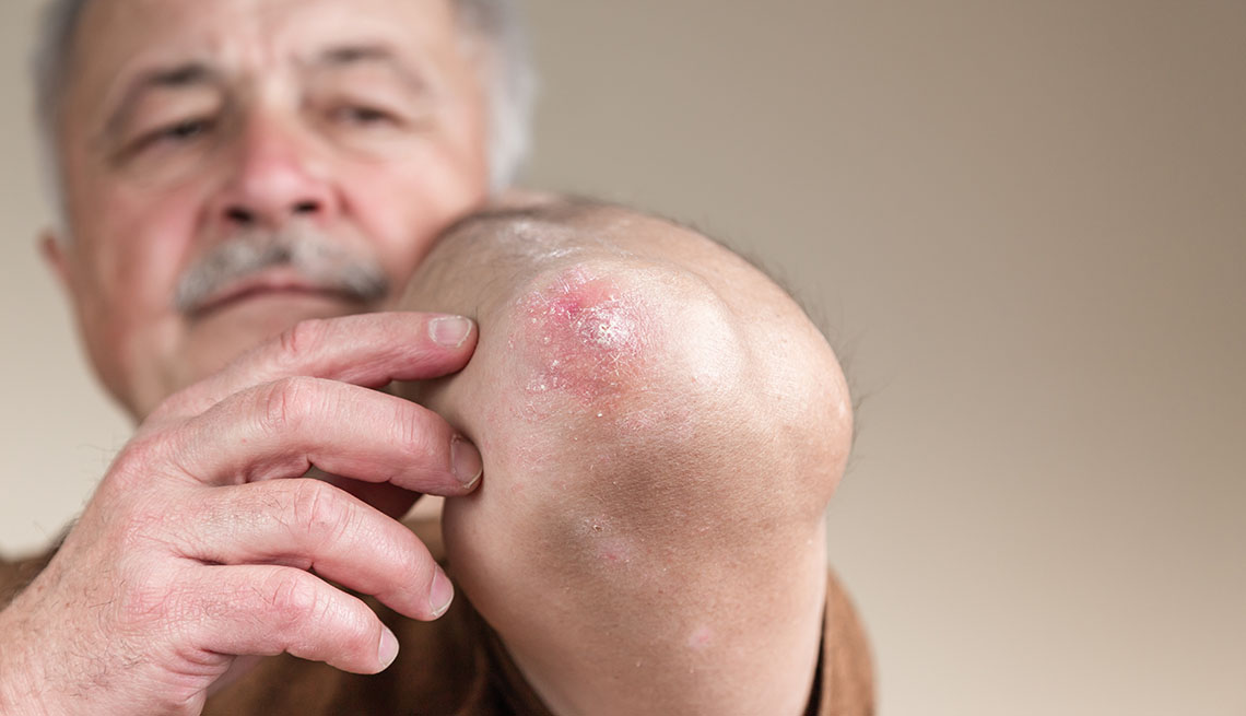 Psoriasis on the elbow. Closeup dermatitis on skin ill allergic rash dermatitis eczema of patient atopic dermatitis symptom skin detail texture, Fungus concept dermatology, treatment fungal and fungal