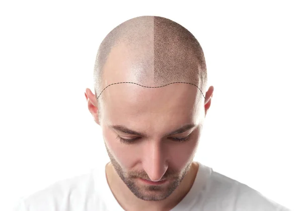 Hair-Transplantation-is-a-surgical-procedure