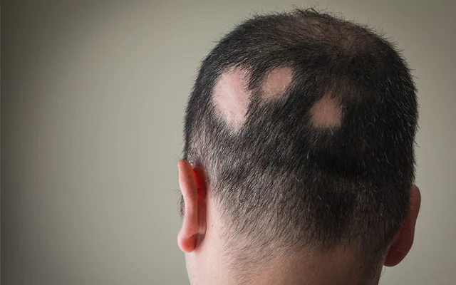 alopecia areata