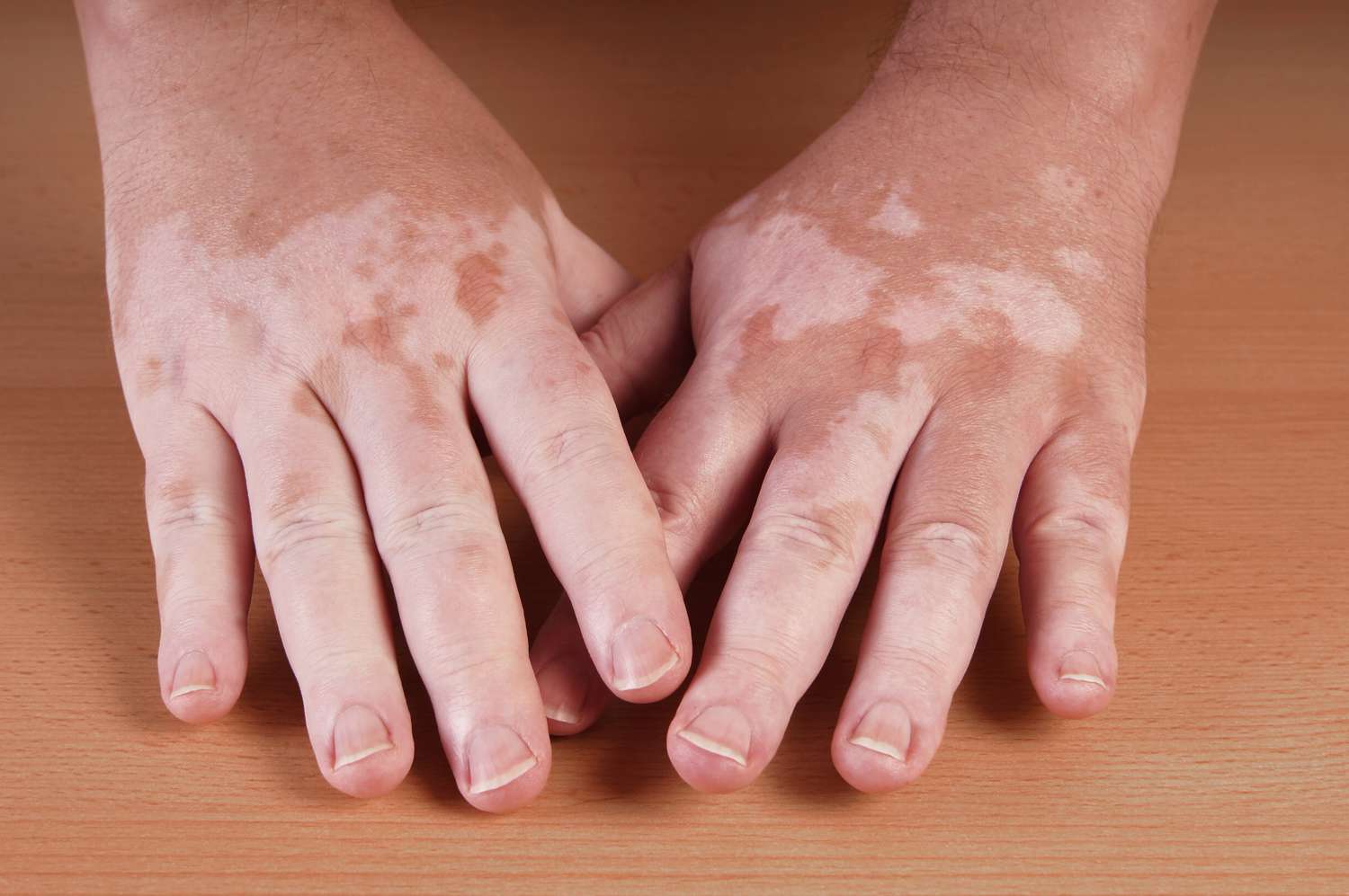 vitiligo-58d307df3df78c5162639661