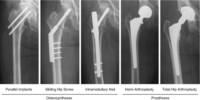 Hip Fracture